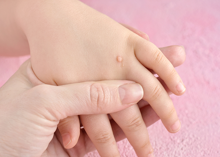Папиллома у ребенка препарат веррукацид
