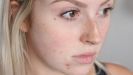 Сыпь на лице при демодексе лечение