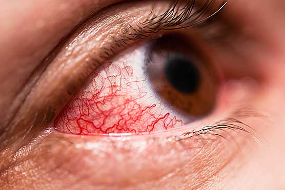 эритромицин мазь для глаз