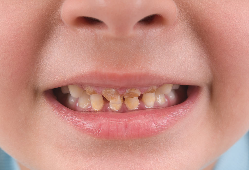 Дисколоризация зубов у детей