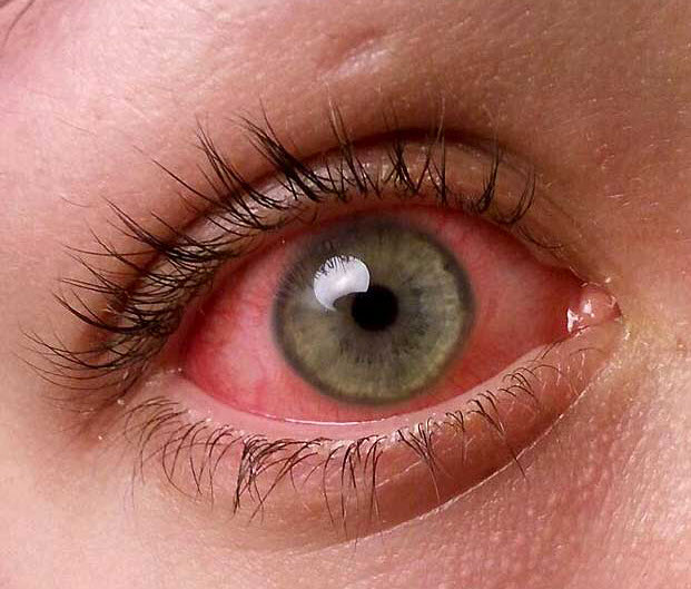 заболевания глаз