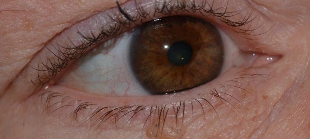 Папилломы в области глаз
