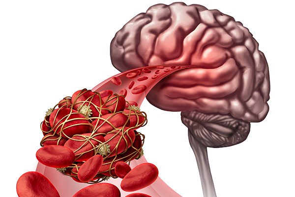 Тромбоз сосудов головного мозга