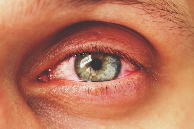 синдром красного глаза